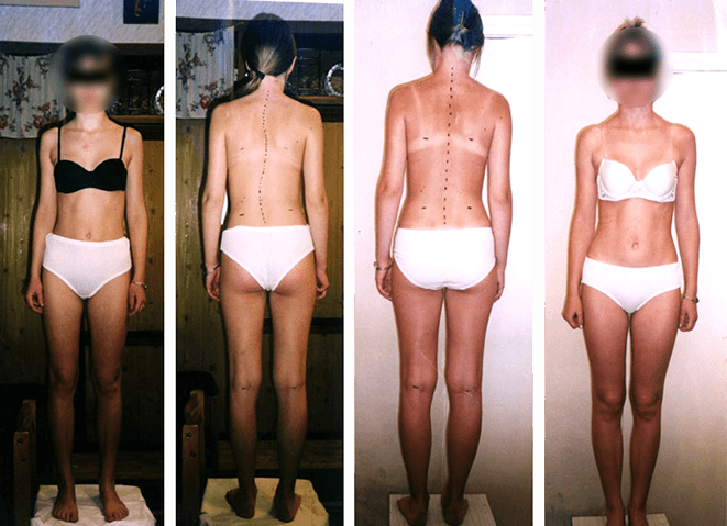 Scoliosis treatment result — clinical case 1, before and after