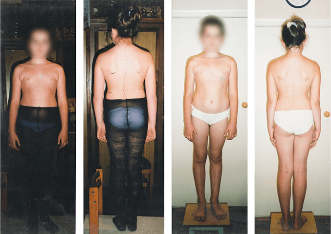 Scoliosis treatment result — clinical case 10, before and after