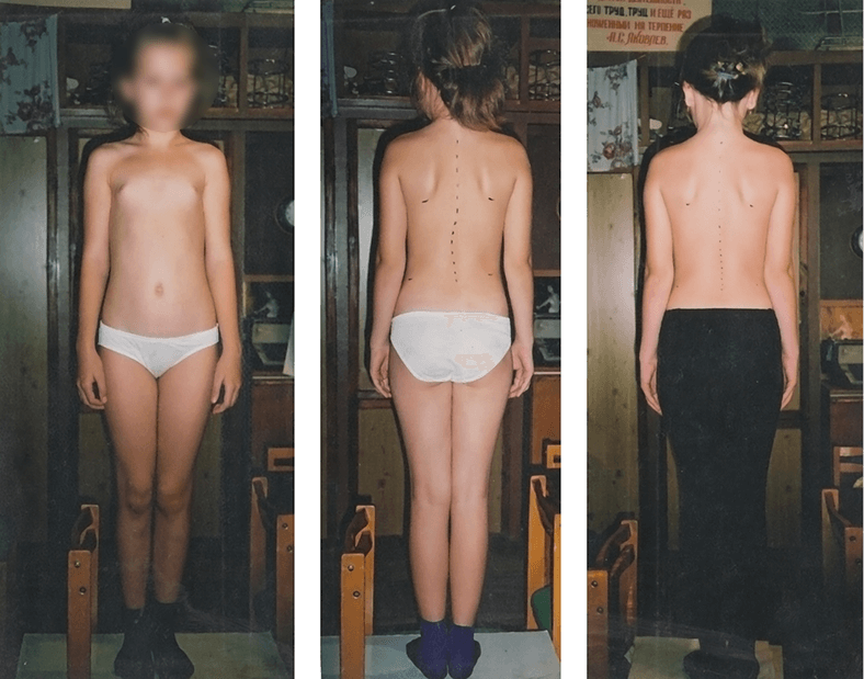 Scoliosis treatment result — clinical case 11, before and after