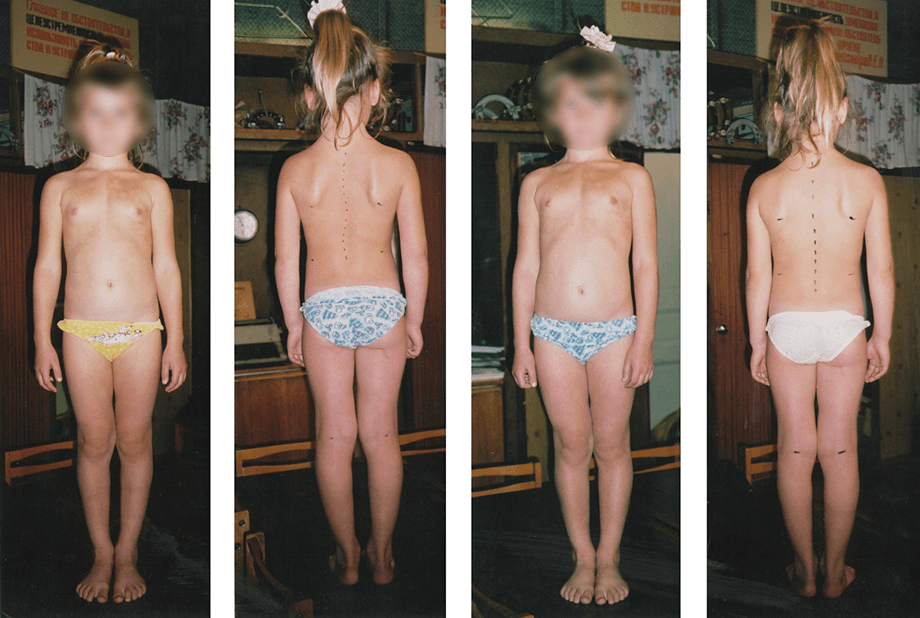 Scoliosis treatment result — clinical case 12, before and after