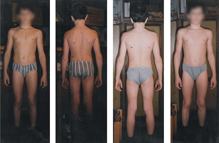 Scoliosis treatment result — clinical case 13, before and after