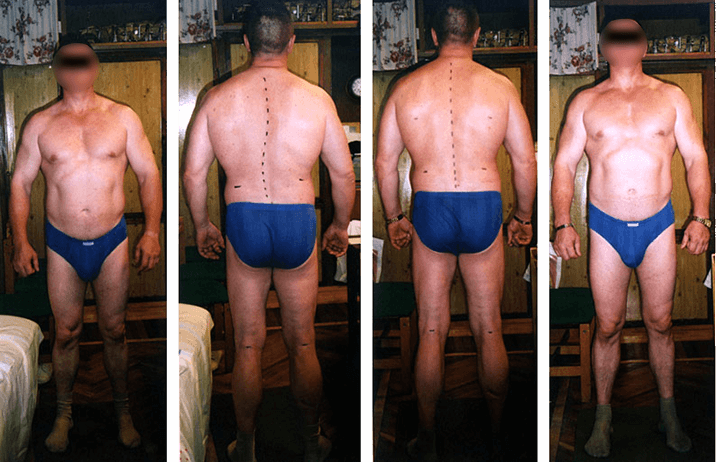 Scoliosis treatment result — clinical case 2, before and after