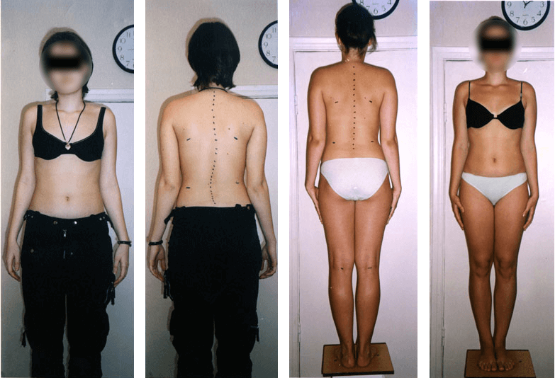 Scoliosis treatment result — clinical case 3, before and after