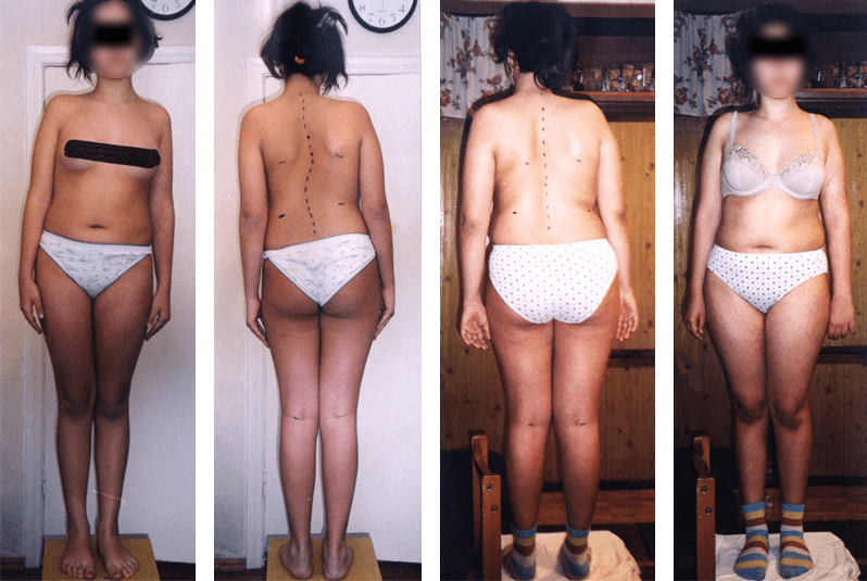 Scoliosis treatment result — clinical case 4, before and after