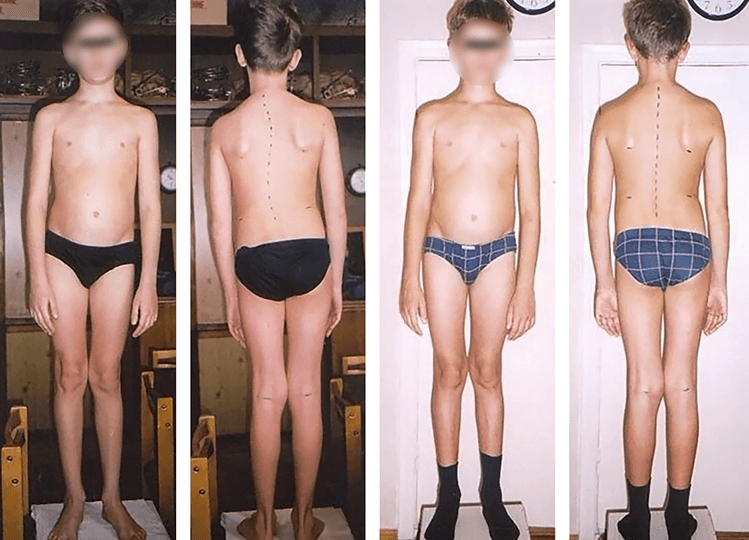 Scoliosis treatment result — clinical case 5, before and after