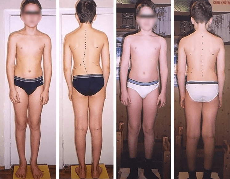 Scoliosis treatment result — clinical case 6, before and after