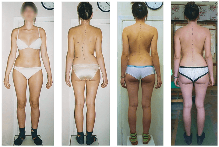 Scoliosis treatment result — clinical case 7, before and after