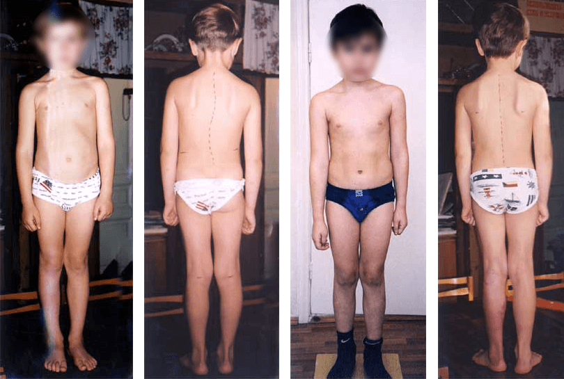 Scoliosis treatment result — clinical case 8, before and after