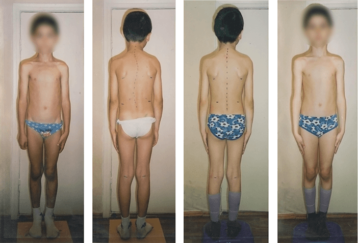 Scoliosis treatment result — clinical case 9, before and after