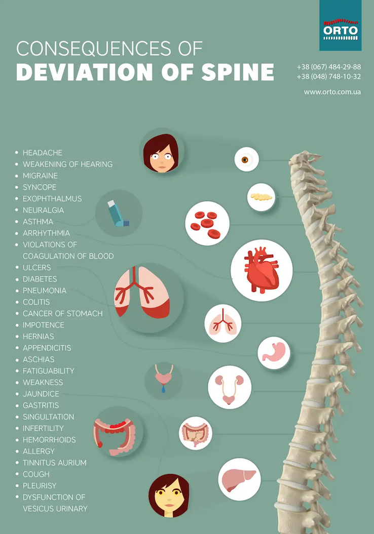 Scoliosis treatment biomechanics scheme — Prof. Serdyuk